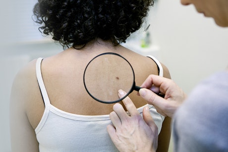 Doctor examining a patient's mole during a skin check for Melanoma screening